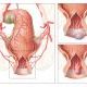 Anatomie van het rectum en aambeien.